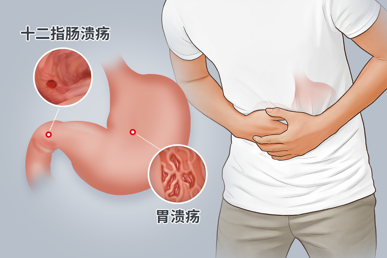 【健康科普】季节交替，胃“溃”难防？这份应对指南请收好