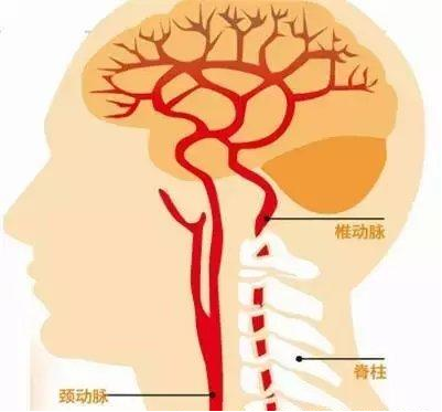 【健康科普】预防脑卒中的第一道防线--颈部血管超声检查