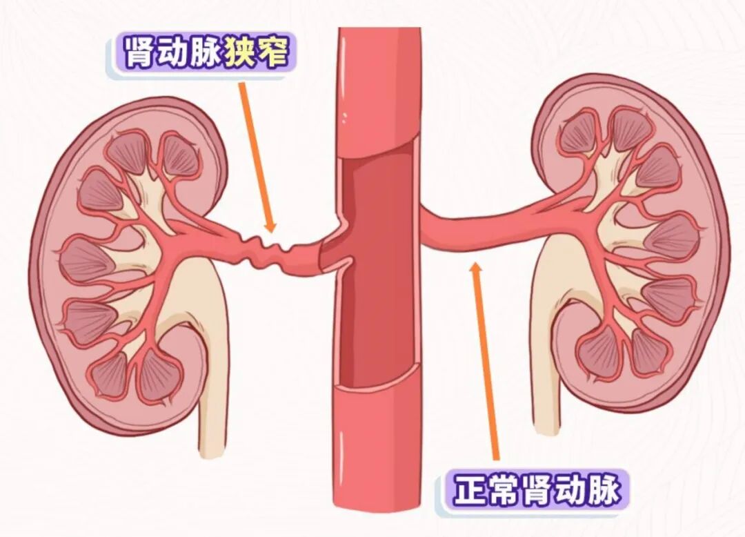 肾动脉与高血压