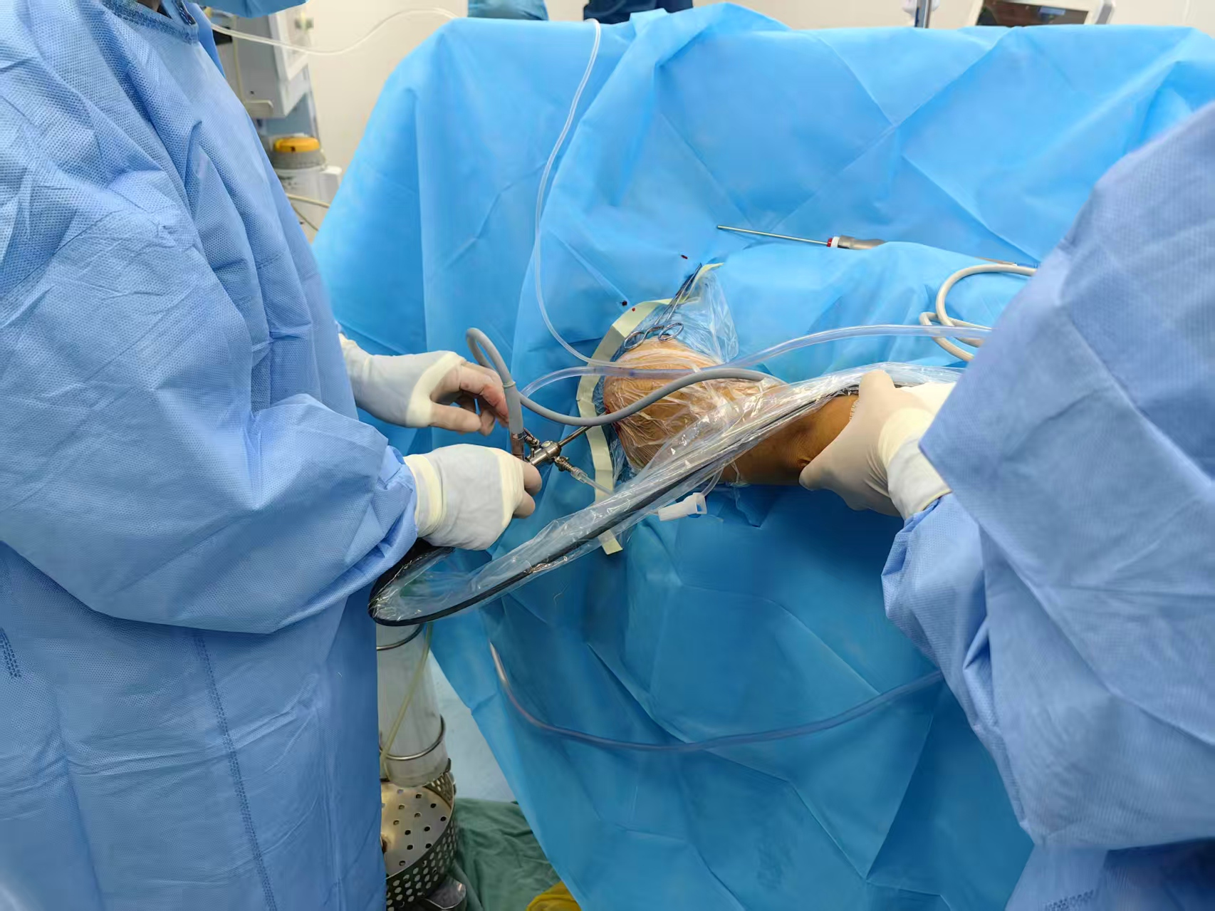 通用医疗西安医院骨一科团队成功完成首例关节镜下肩关节探查+肩袖修复术