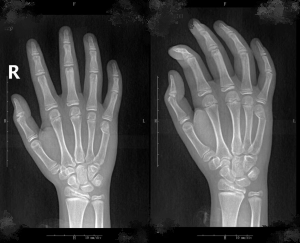 微创巧治“拳击手骨折”， 12岁少年三天返校复学